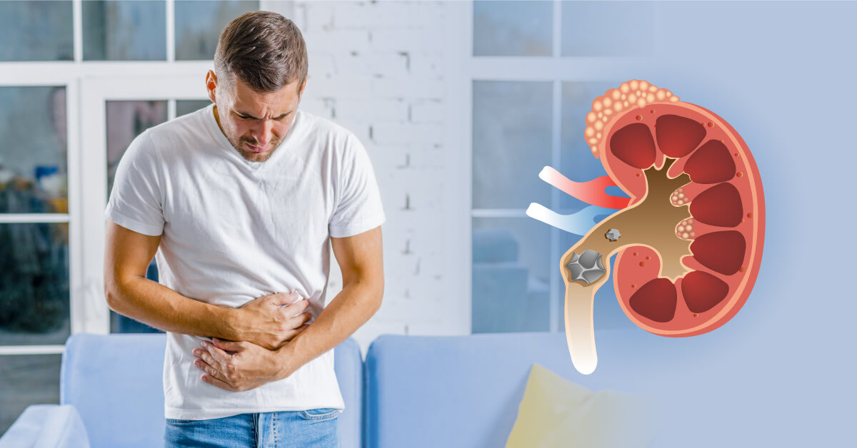 Kidney stones: Causes, Symptoms, Treatment and Prevention
