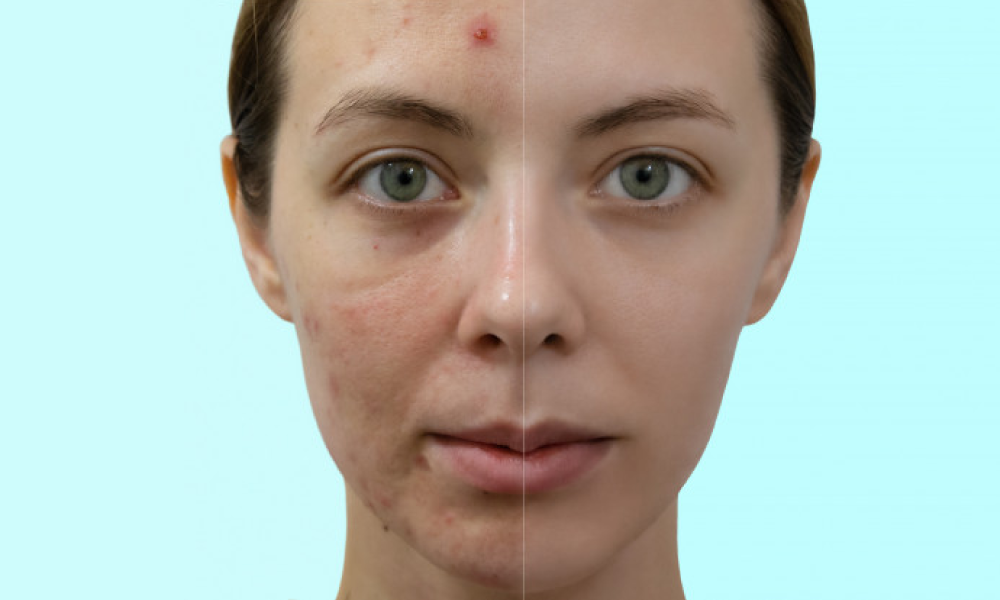 Acne Treatment Before and After - Remedyspace
