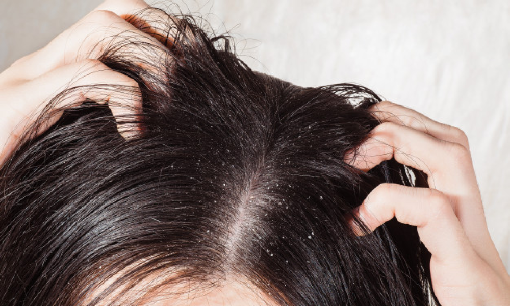 Dry scalp in winter - Remedyspace health app